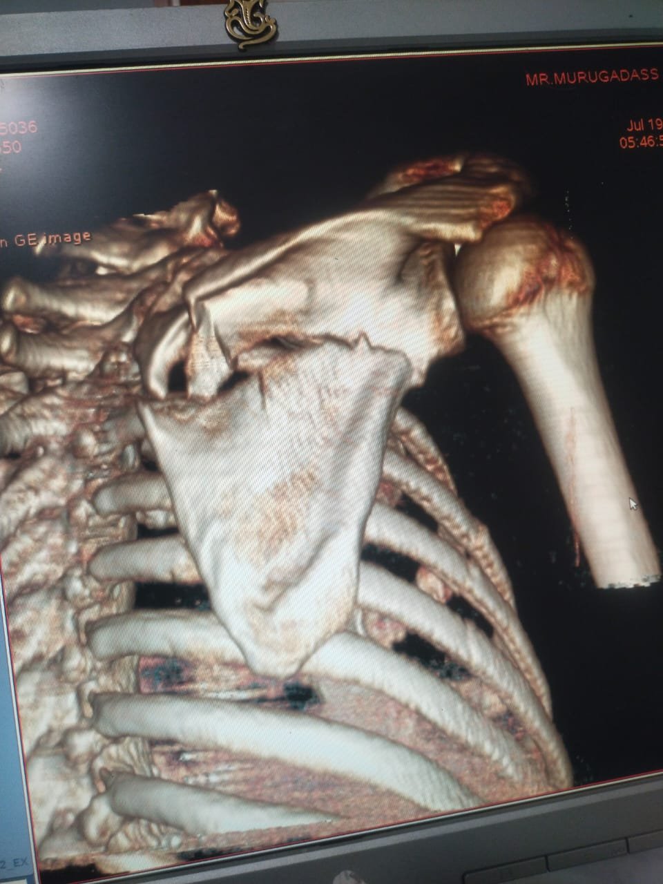 Shoulder Girdle ORIF Case